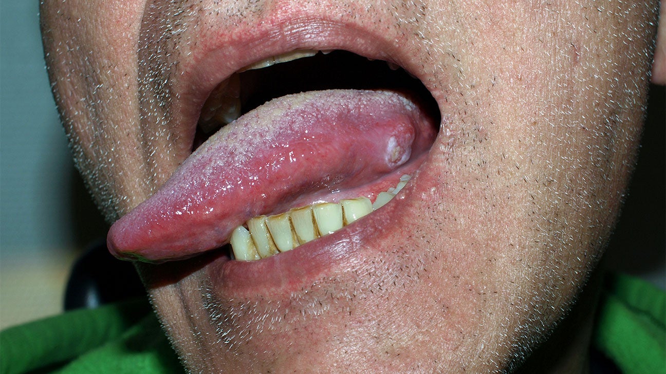 squamous cell carcinoma tongue stage 1