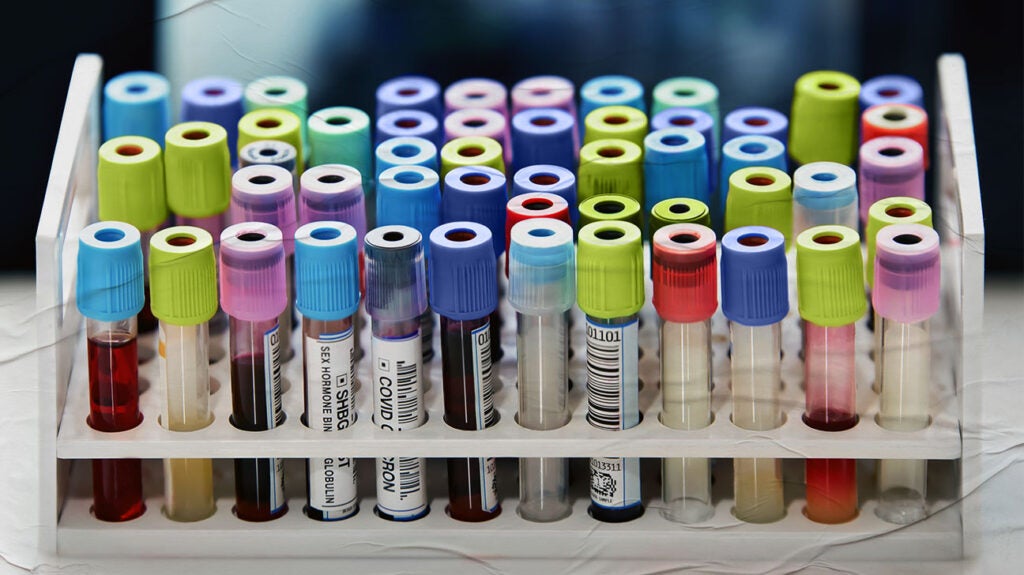 Lab tests for hemophilia: Results and other tests