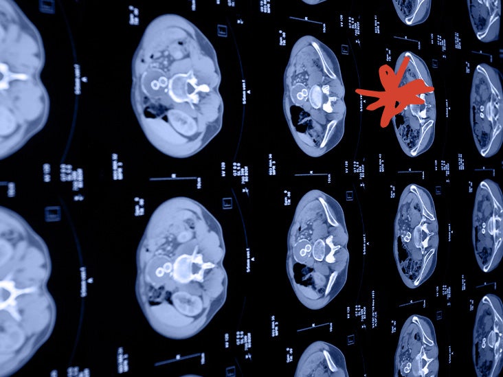 acute-vs-chronic-renal-failure-differences-explained