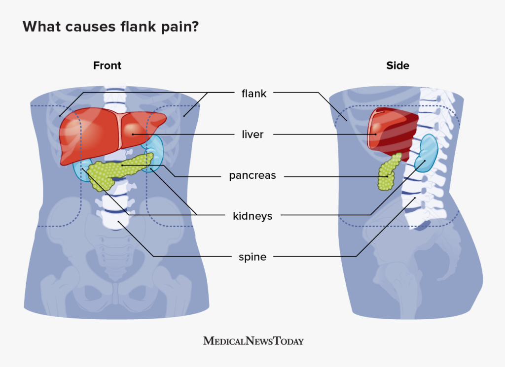 Flank Pain: Causes, Symptoms, and Diagnosis