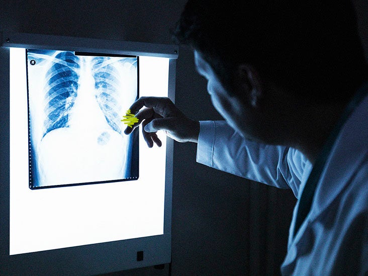 Lung disease: Radiologists outperform AI in diagnosing via chest X-ray - Vimarsana News