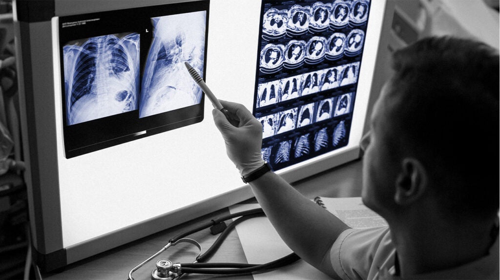 Lung cancer: CT scan screenings can vastly improve long-term survival